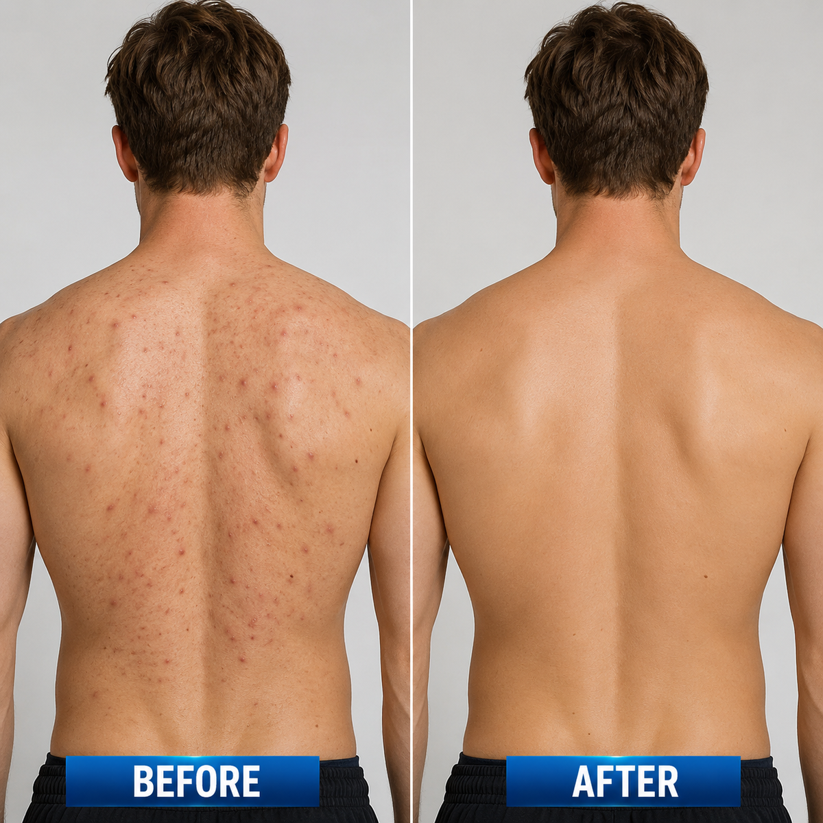🔥 【Official Store】PURELORA® 4-in-1 Spray — Acne Clear · Fade Marks · Smooth Bumps · Exfoliating Mist | Salicylic Acid + Menthol + Caffeine + Tea Tree | Made in UK