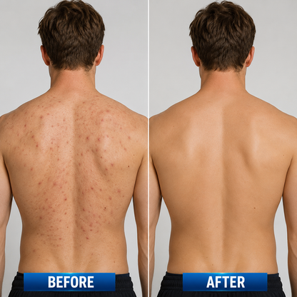 🔥 【Official Store】PURELORA® 4-in-1 Spray — Acne Clear · Fade Marks · Smooth Bumps · Exfoliating Mist | Salicylic Acid + Menthol + Caffeine + Tea Tree | Made in UK