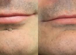 🏥 Curalona® 2-in-1 Microneedle & Hydrocolloid Patches 🍀 | Targets Skin Tags, Flat Warts & Raised Bumps | Invisible Face & Body Patches | No Clinic Visit Needed