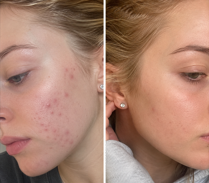 🔥 【Official Store】PURELORA® 4-in-1 Spray — Acne Clear · Fade Marks · Smooth Bumps · Exfoliating Mist | Salicylic Acid + Menthol + Caffeine + Tea Tree | Made in UK