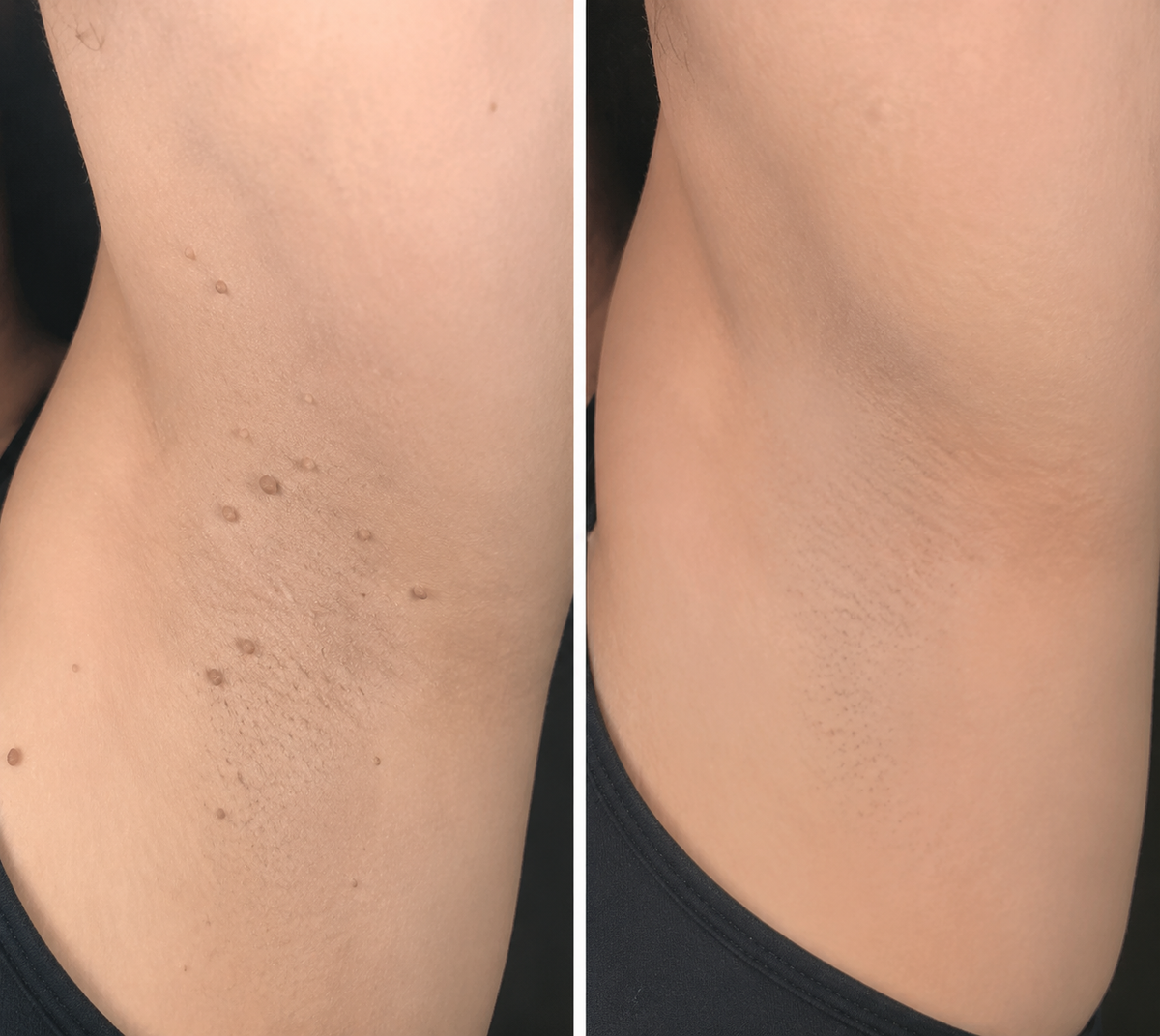 🏥 Curalona® 2-in-1 Microneedle & Hydrocolloid Patches 🍀 | Targets Skin Tags, Flat Warts & Raised Bumps | Invisible Face & Body Patches | No Clinic Visit Needed