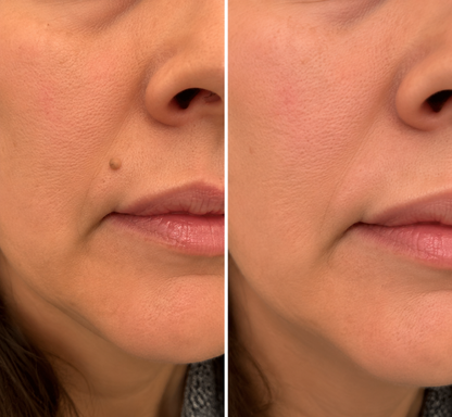 🏥 Curalona® 2-in-1 Microneedle & Hydrocolloid Patches 🍀 | Targets Skin Tags, Flat Warts & Raised Bumps | Invisible Face & Body Patches | No Clinic Visit Needed
