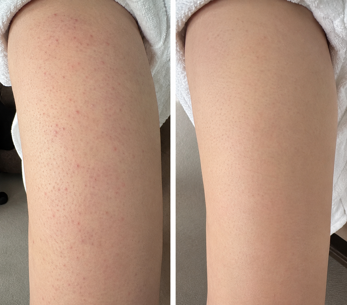 🔥 【Official Store】PURELORA® 4-in-1 Spray — Acne Clear · Fade Marks · Smooth Bumps · Exfoliating Mist | Salicylic Acid + Menthol + Caffeine + Tea Tree | Made in UK