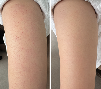 🔥 【Official Store】PURELORA® 4-in-1 Spray — Acne Clear · Fade Marks · Smooth Bumps · Exfoliating Mist | Salicylic Acid + Menthol + Caffeine + Tea Tree | Made in UK