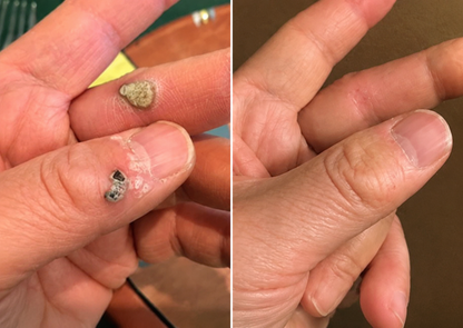 🏥 Curalona® 2-in-1 Microneedle & Hydrocolloid Patches 🍀 | Targets Skin Tags, Flat Warts & Raised Bumps | Invisible Face & Body Patches | No Clinic Visit Needed